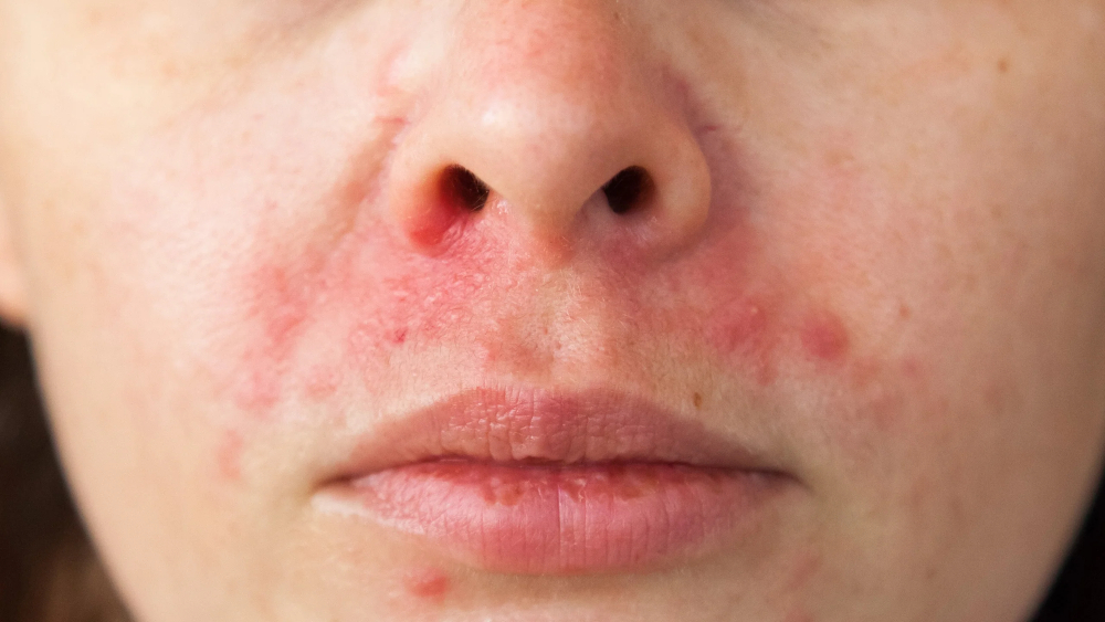obraznidermatitis.jpg